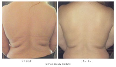Inmode RF Body Contouring (Body Fx) Before & After