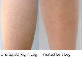 Dialaze Before & After