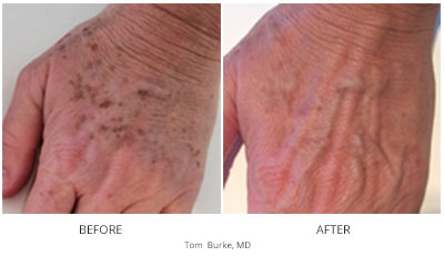 Inmode IPL Skin Rejuvenation (Lumecca) Before & After