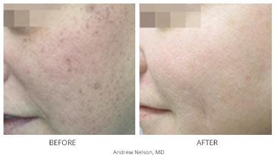 Inmode IPL Skin Rejuvenation (Lumecca) Before & After
