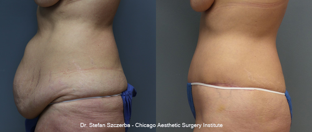 Tummy Tuck with Hernia Repair | Age 61 | Height 5'6" | Weight 150 lbs