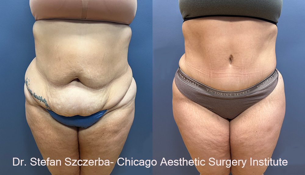 Tummy tuck with lipo
Age 30
5’05
240lbs.