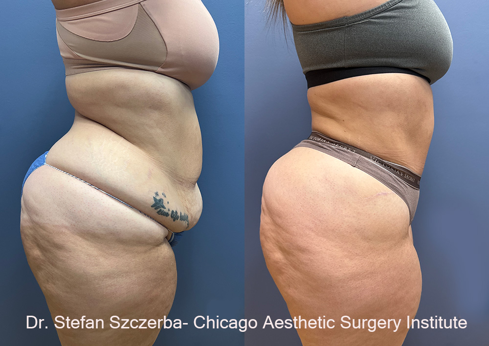 Tummy tuck with lipo
Age 30
5’05
240lbs.
