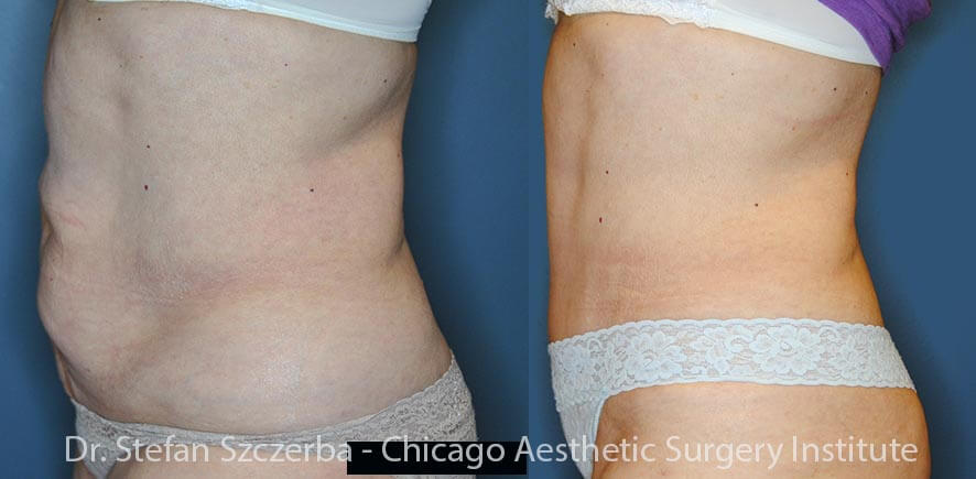 Tummy Tuck – Age 75-80 – Height 5’2” – Weight 150