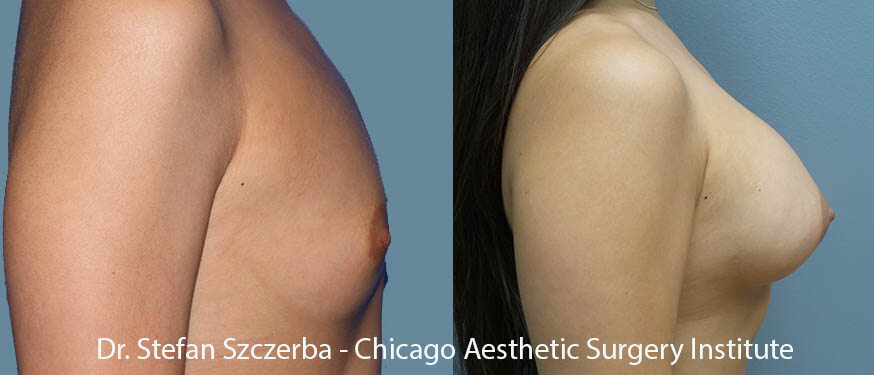 Allergan Natrelle Silicone Right 20HP-300cc, Left 20HP-280cc. Age 25-30 – Height 5’5” – Weight 105 lbs Allergan Natrelle Silicone Right 20HP-300cc, Left 20HP-280cc. Age 25-30 – Height 5’5” – Weight 105 lbs