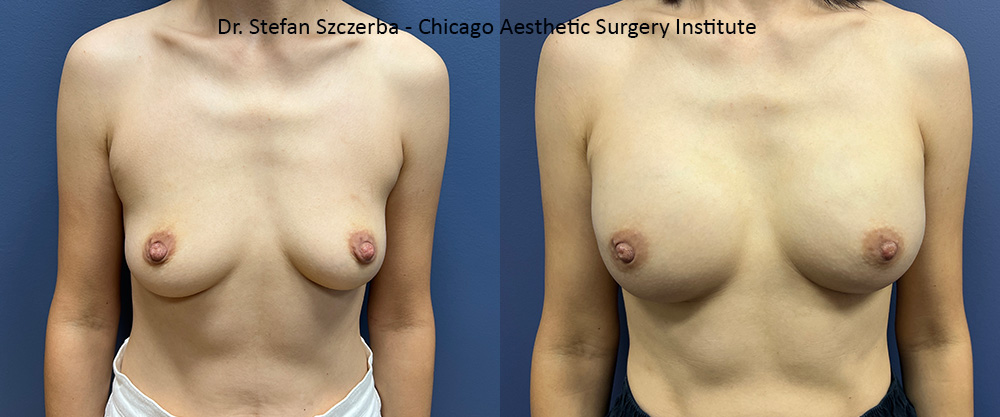 Breast reconstruction
Age 50
Height 5' 5"
Weight 110 lbs