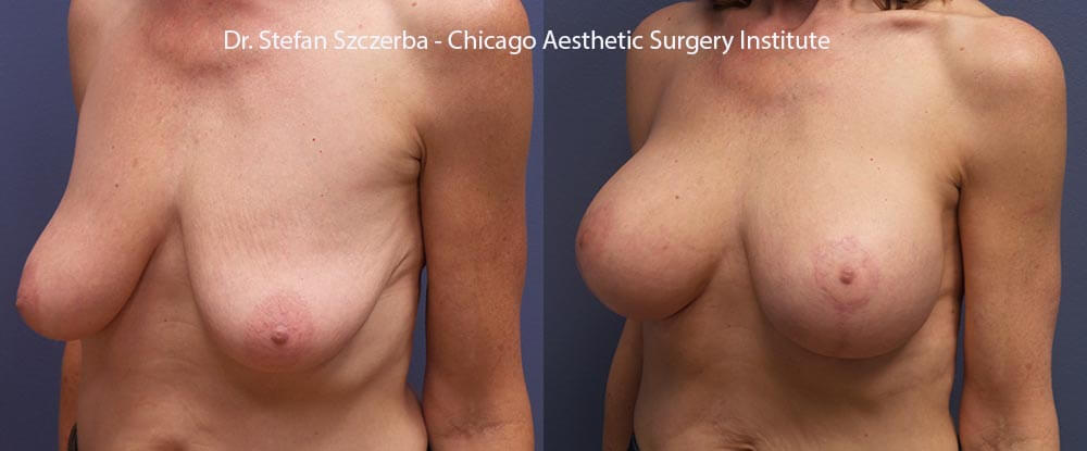 Anchor Lift with implant, treated for asymmetry. Allergan Natrelle Style 20-375cc Right, 20-400cc left. Age 55-60 – Height 5’6” – Weight 138 lbs.