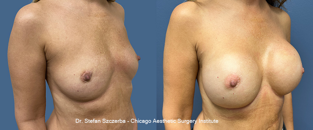 Breast Reconstruction with Fat Graft,
Mentor Memory Gel Boost - 685cc | Age 50 | Height 5'2" | Weight 115 lbs.