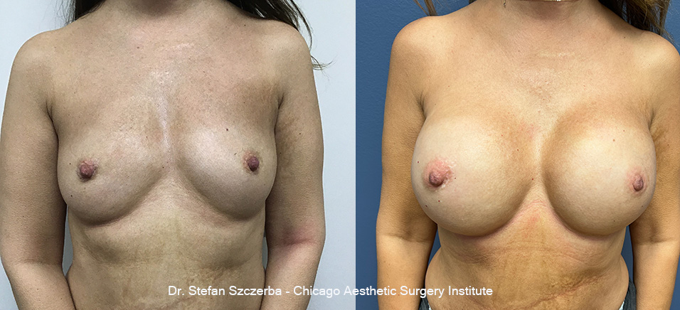 Breast Reconstruction with Fat Graft,
Mentor Memory Gel Boost - 685cc | Age 50 | Height 5'2" | Weight 115 lbs.