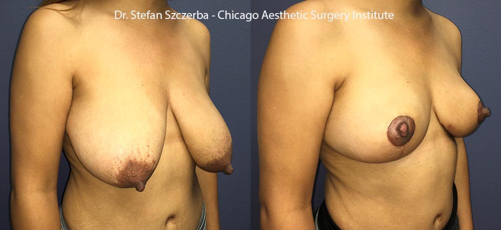 Breast Reduction – Age 35-40 – Height 5’0” – Weight 115 lbs
