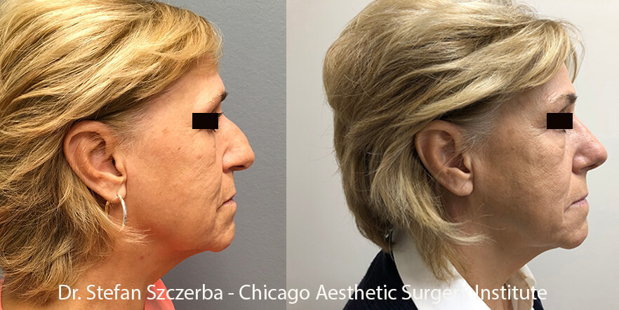 Rhinoplasty with Septoplasty – Age 65-70 – Height 5’2” – Weight 145 lbs