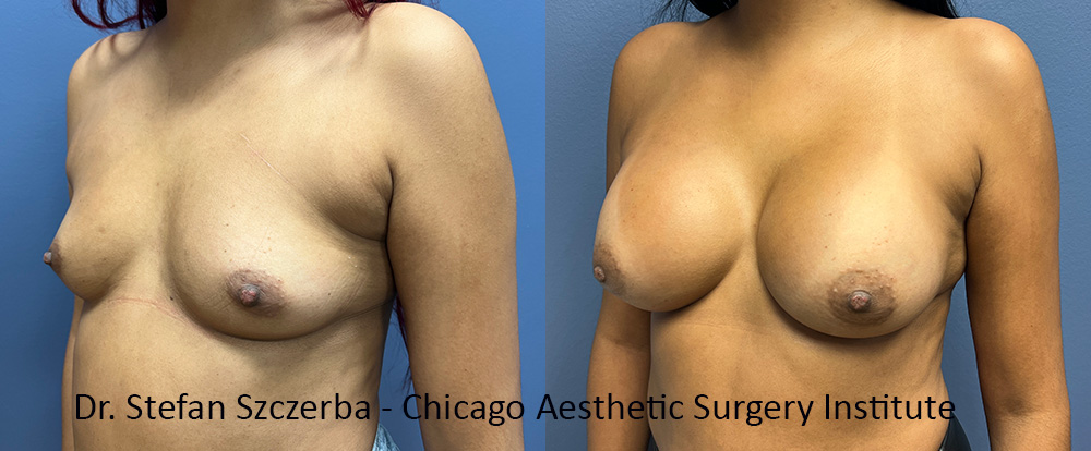 breast augmentation images