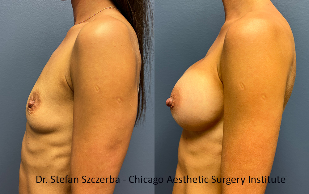 breast augmentation images
