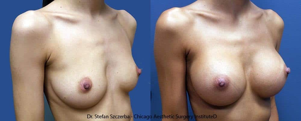 Replaced Allergan Natrelle Silicone FP Style 45-320 with Allergan Natrelle Silicone FP Style 45 – 36 Age 25-30 – Height 5’6” – Weight 115 lbs.