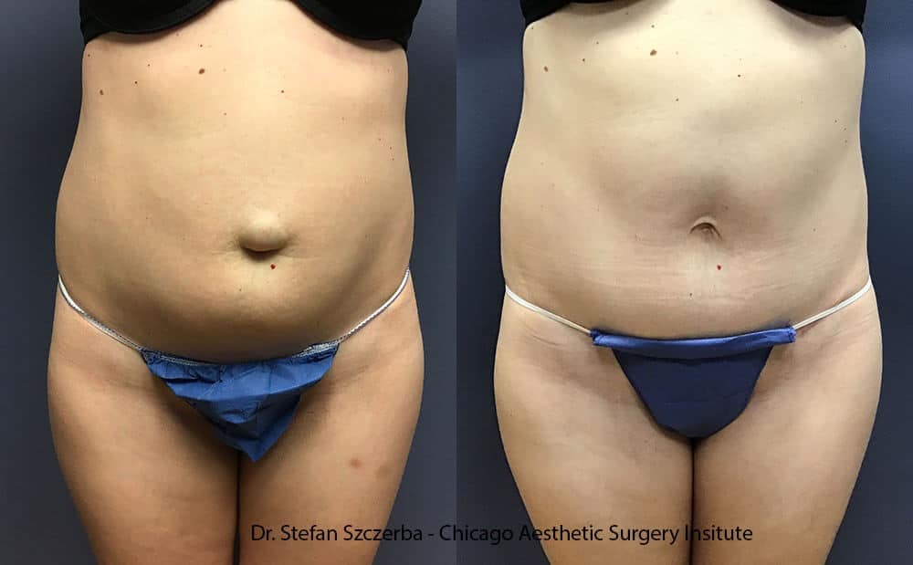 Repair umbilical hernia with excision of overhanging skin – Age 40-45 – Height 5’6” – Weight 125 lbs Repair umbilical hernia with excision of overhanging skin – Age 40-45 – Height 5’6” – Weight 125 lbs