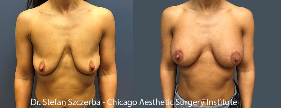 Anchor Lift with implants – Allergan Natrelle inspira SRX-285cc. Age 35-40 – Height 4’11” – Weight 103 lbs.