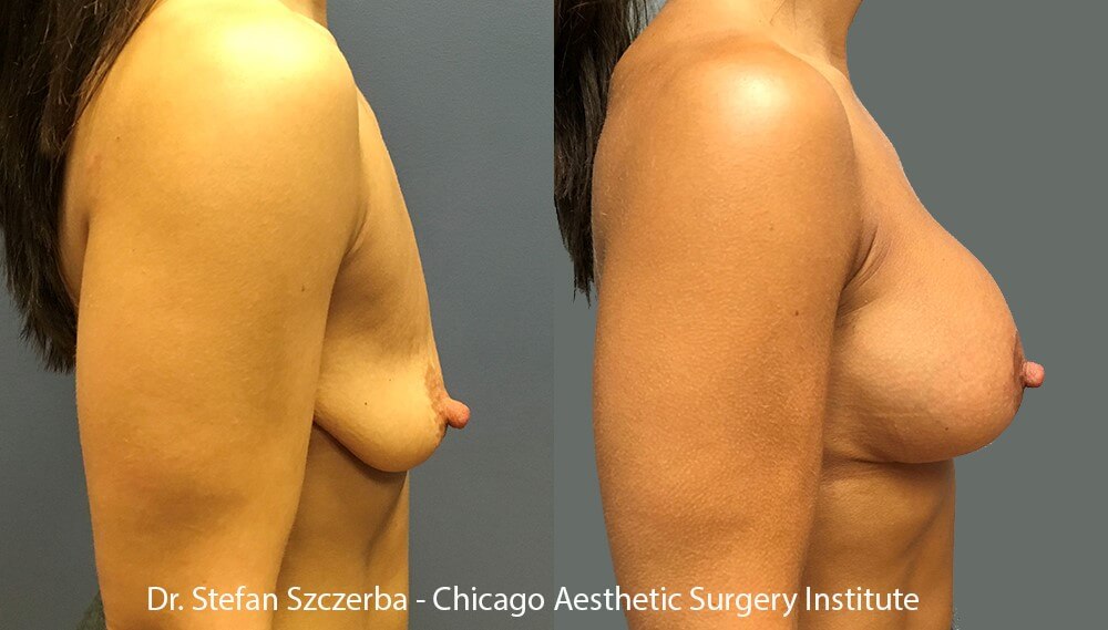 Anchor Lift with implants – Allergan Natrelle inspira SRX-285cc. Age 35-40 – Height 4’11” – Weight 103 lbs.