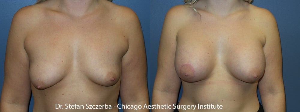 Small lift on right side to correct asymmetry. Allergan silicone 45-460cc. Age 26 – Height 5’3” – Weight 155 lbs