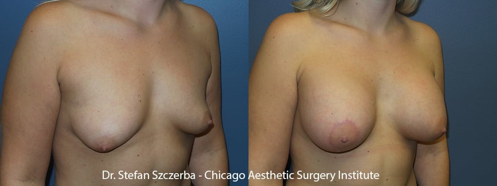Small lift on right side to correct asymmetry. Allergan silicone 45-460cc. Age 26 – Height 5’3” – Weight 155 lbs