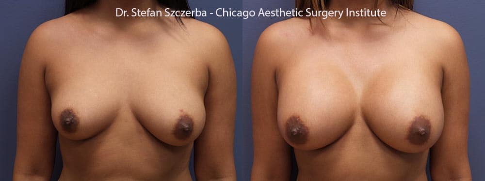 Allergan Natrelle Silicone High Profile Style 20-450cc right side, 20-400cc left side. Correction for asymmetry.