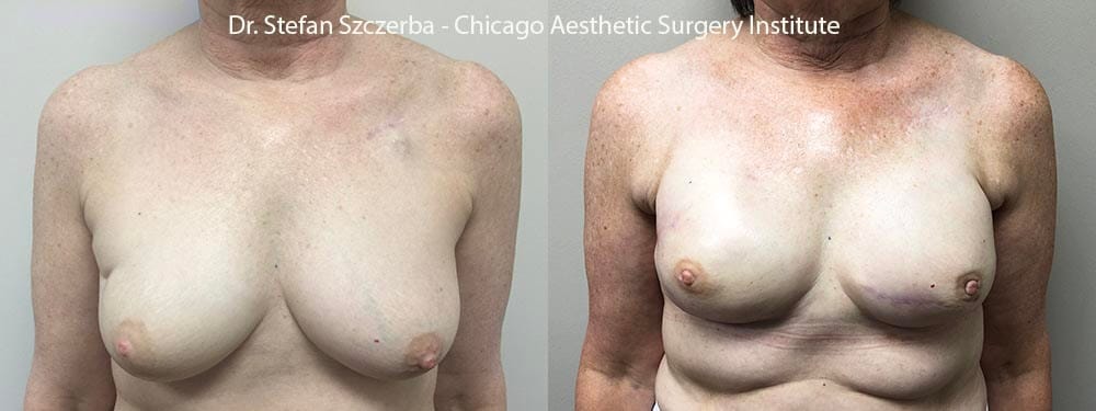 Bilateral reconstruction after breast cancer. Bilateral revision, including capsloyomy, implant replacement and fat graft. Age 55-60 – Height 5’4´- Weight 145 lbs. Breast Reconstrucion