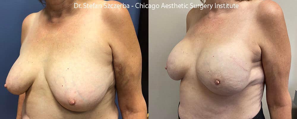 Bilateral reconstruction after mastectomy. Allergan SCF 605cc implants, AlloDerm scaffolding used to keep the implants in place. Age 55-60 – Height 5’5” – Weight 155 lbs.