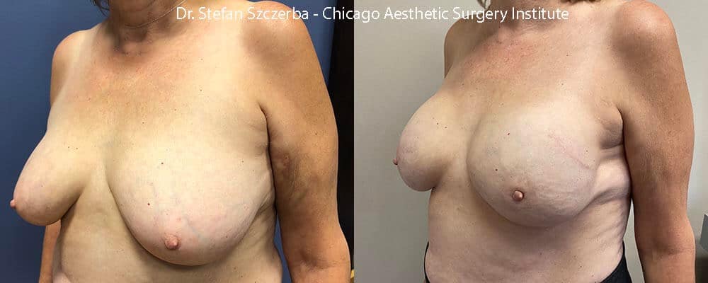Bilateral reconstruction after mastectomy. Allergan SCF 605cc implants, AlloDerm scaffolding used to keep the implants in place. Age 55-60 – Height 5’5” – Weight 155 lbs. Bilateral reconstruction after mastectomy. Allergan SCF 605cc implants, AlloDerm scaffolding used to keep the implants in place. Age 55-60 – Height 5’5” – Weight 155 lbs.
