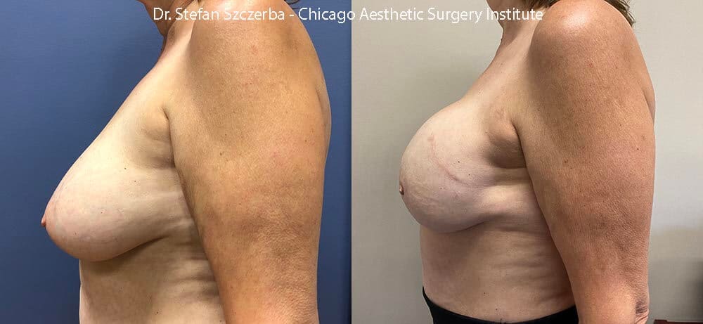 Bilateral reconstruction after mastectomy. Allergan SCF 605cc implants, AlloDerm scaffolding used to keep the implants in place. Age 55-60 – Height 5’5” – Weight 155 lbs.