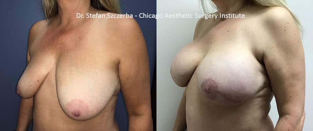 Breast Reconstruction | Allergan silicone implants 133-FX-12-T 450 cc | Age 50-55 | Height 5’3” | Weight 128 lbs