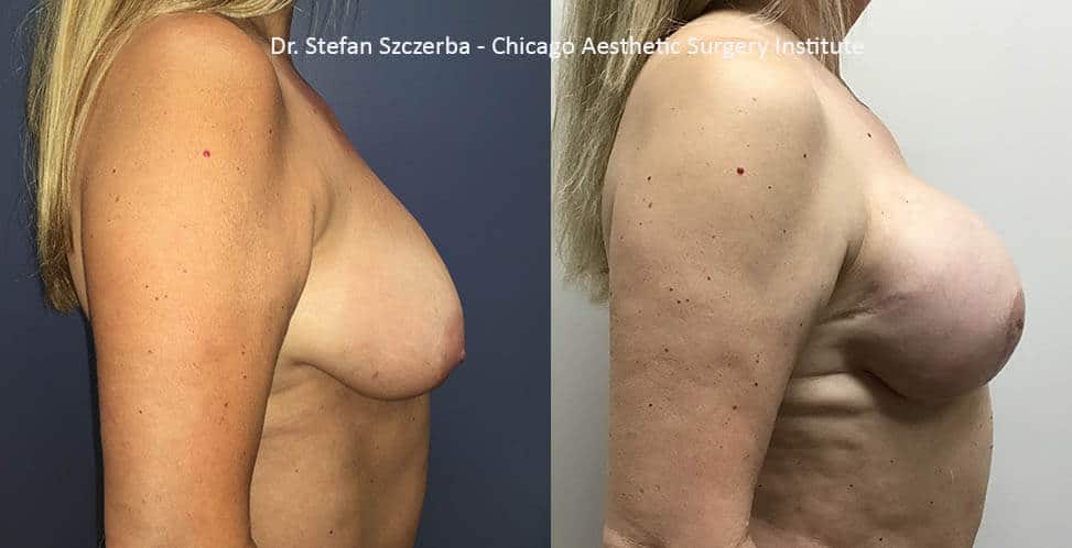 Breast Reconstruction | Allergan silicone implants 133-FX-12-T 450 cc | Age 50-55 | Height 5’3” | Weight 128 lbs