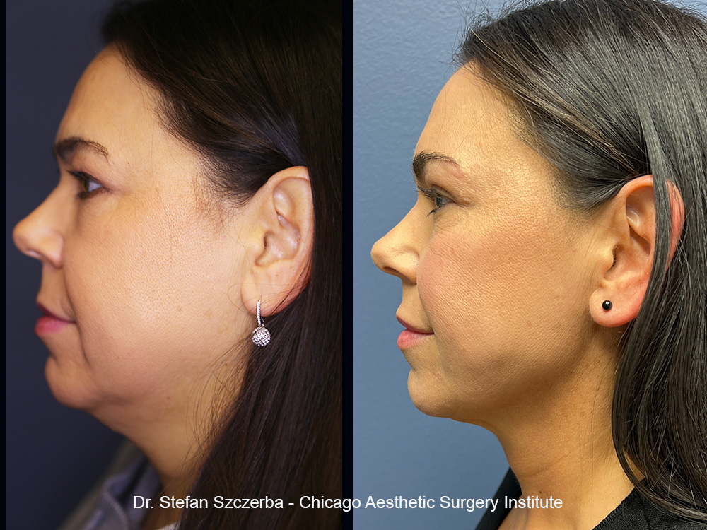 Inmode Accutite/Facetite Chicago Aesthetic Surgery Institute
