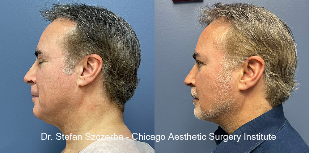 Facetite - Lower face and neck
Age 62
Height 5'11"
Weight 185 lbs