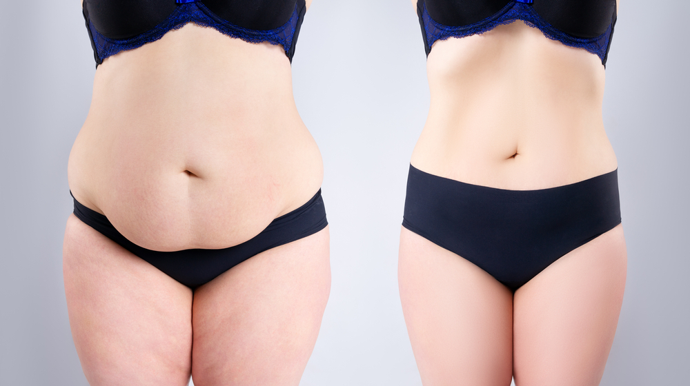 Tummy Tuck Surgery - Chicago Aesthetic Surgery Institute