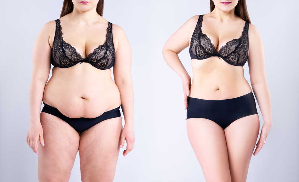 Understanding What’s Involved in a Tummy Tuck | Chicago Aesthetic Surgery Institute