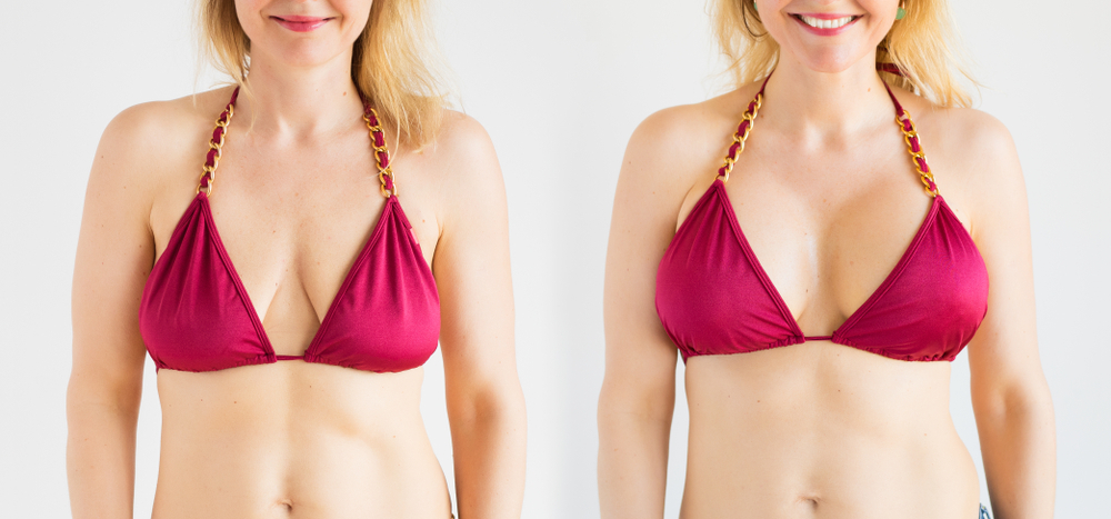 A Comprehensive Guide on How Breast Lifts Are Performed | Chicago Aesthetic Surgery Institute