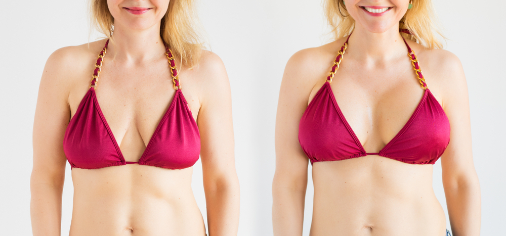 Types Of Breast Lift Incisions  Chicago Breast & Body Aesthetics