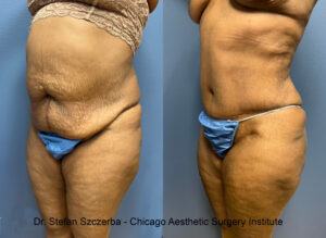 Tummy Tuck Before & After | Chicago Aesthetic Surgery Institute