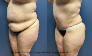 Tummy Tuck Before & After | Chicago Aesthetic Surgery Institute