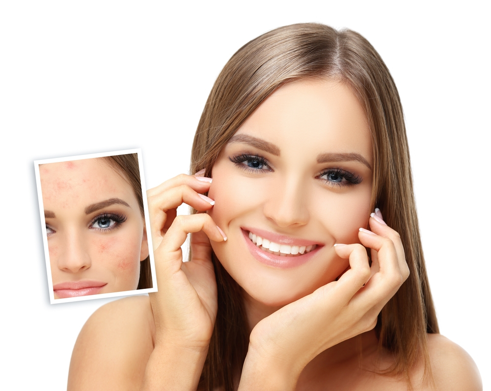 Acne Scars | Chicago Aesthetic Surgery Institute (CASI)