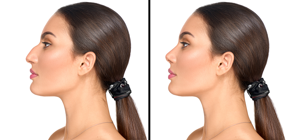 Rhinoplasty | Chicago Aesthetic Surgery Institute (CASI)
