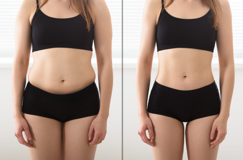 Laser Liposuction | Chicago Aesthetic Surgery Institute (CASI)