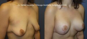 Anchor Lift with implant – Allergan Silicone HP-300cc – Age 20-25 – Height 5’4” = Weight 130 lbs