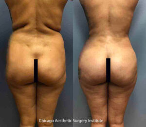 Received Brazilian Butt Lift using SAFEBBL TM procedure