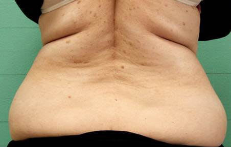 Before BLT Exilis Elite