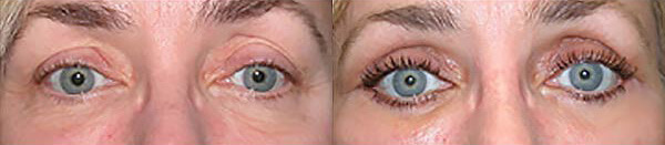 Before-after-eyelid-lift-01