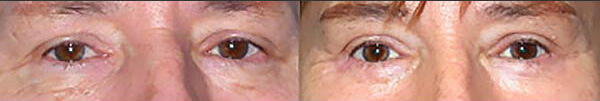 Before-after-eyelid-lift-02
