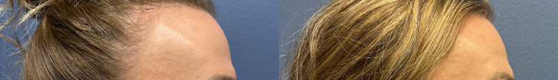 Upper blepharoplasty & browpexy | Age 45