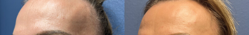 Upper blepharoplasty & browpexy | Age 45