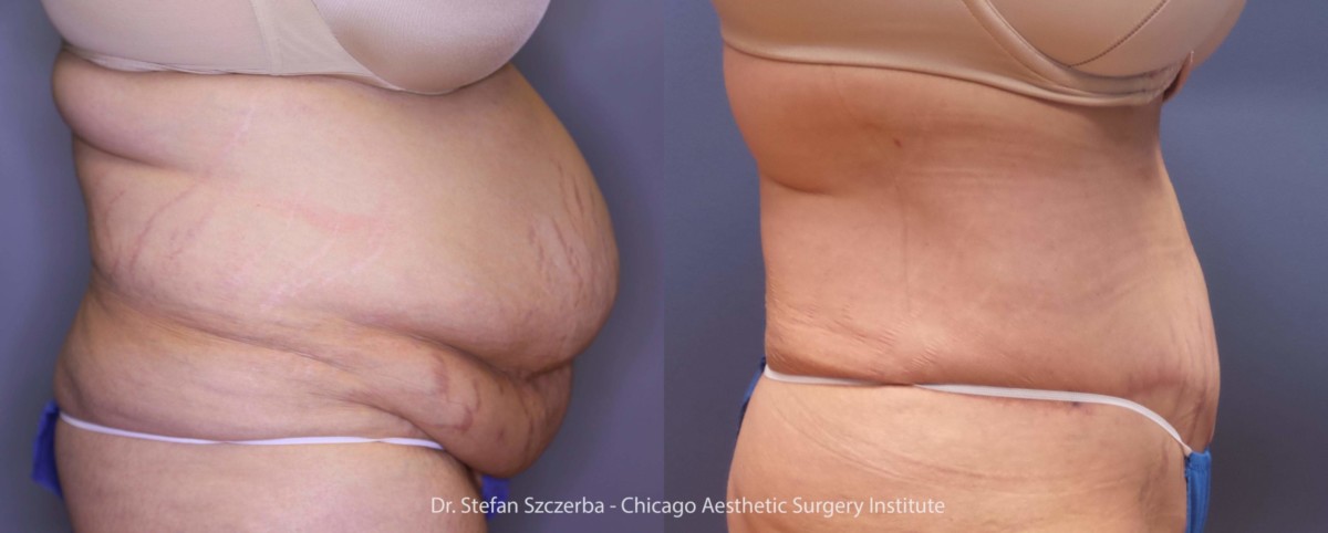 Tummy Tuck – Age 40-45 – Height 5’7” – Weight 246 lbs