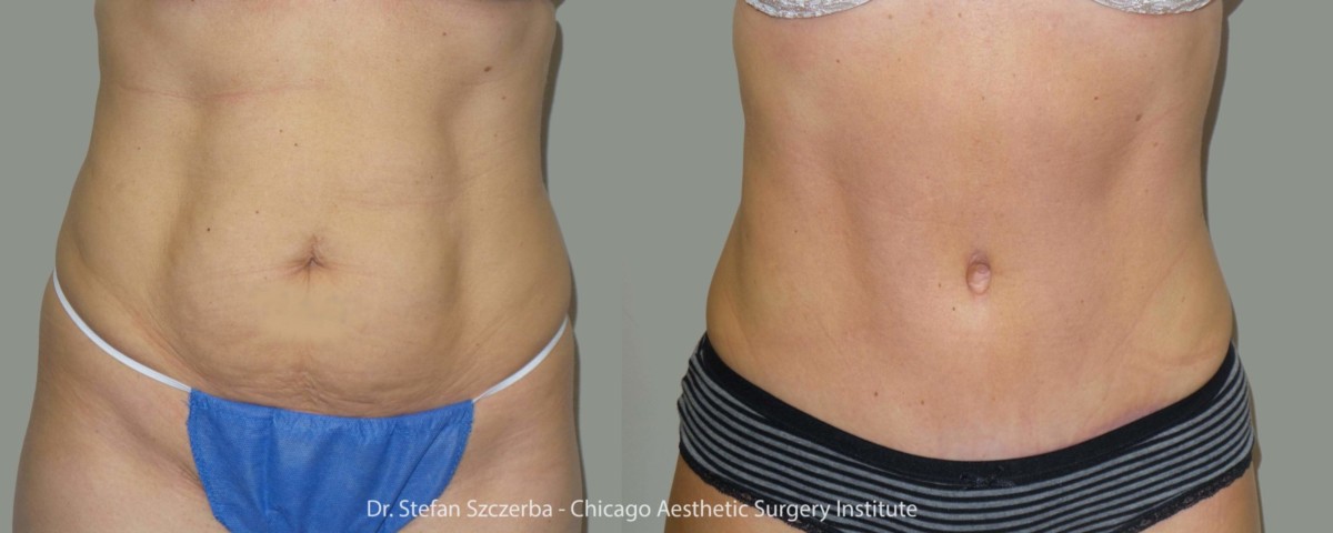 Tummy Tuck – Age 35 – 40 – Height 5’2” – Weight 135 lbs
